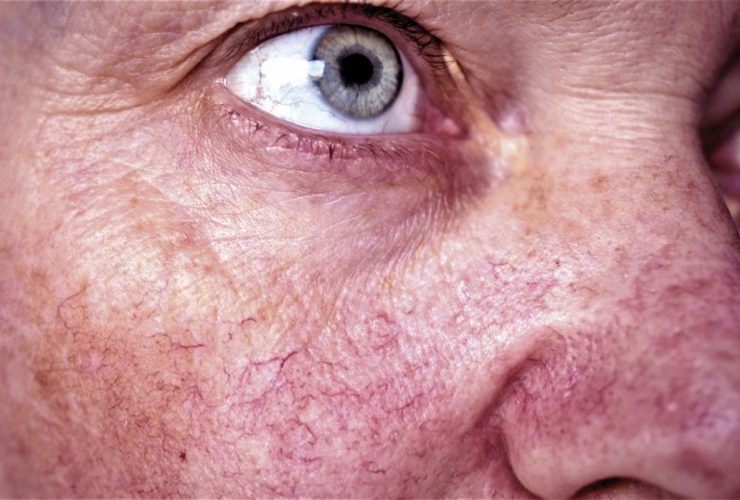 rosacea