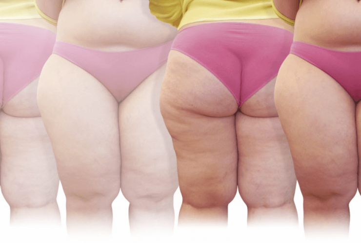 lipedema