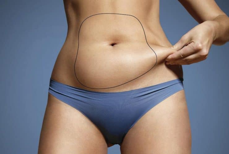 liposuccion abdominal