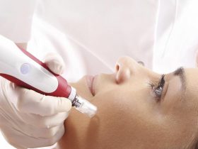 microneedling