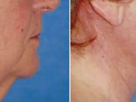 rejuvenecimiento facial