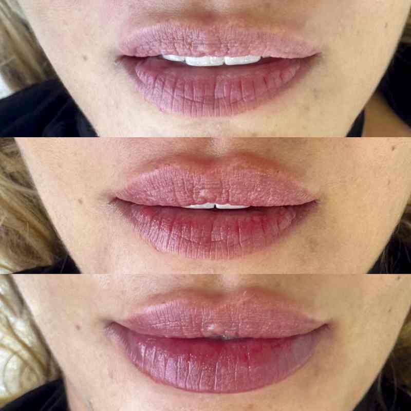 Labios que desafían el tiempo | Expertos en medicina estética