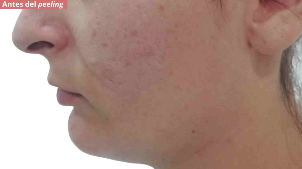 acne vulgaris