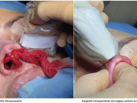 Rinoplastia ultrasónica