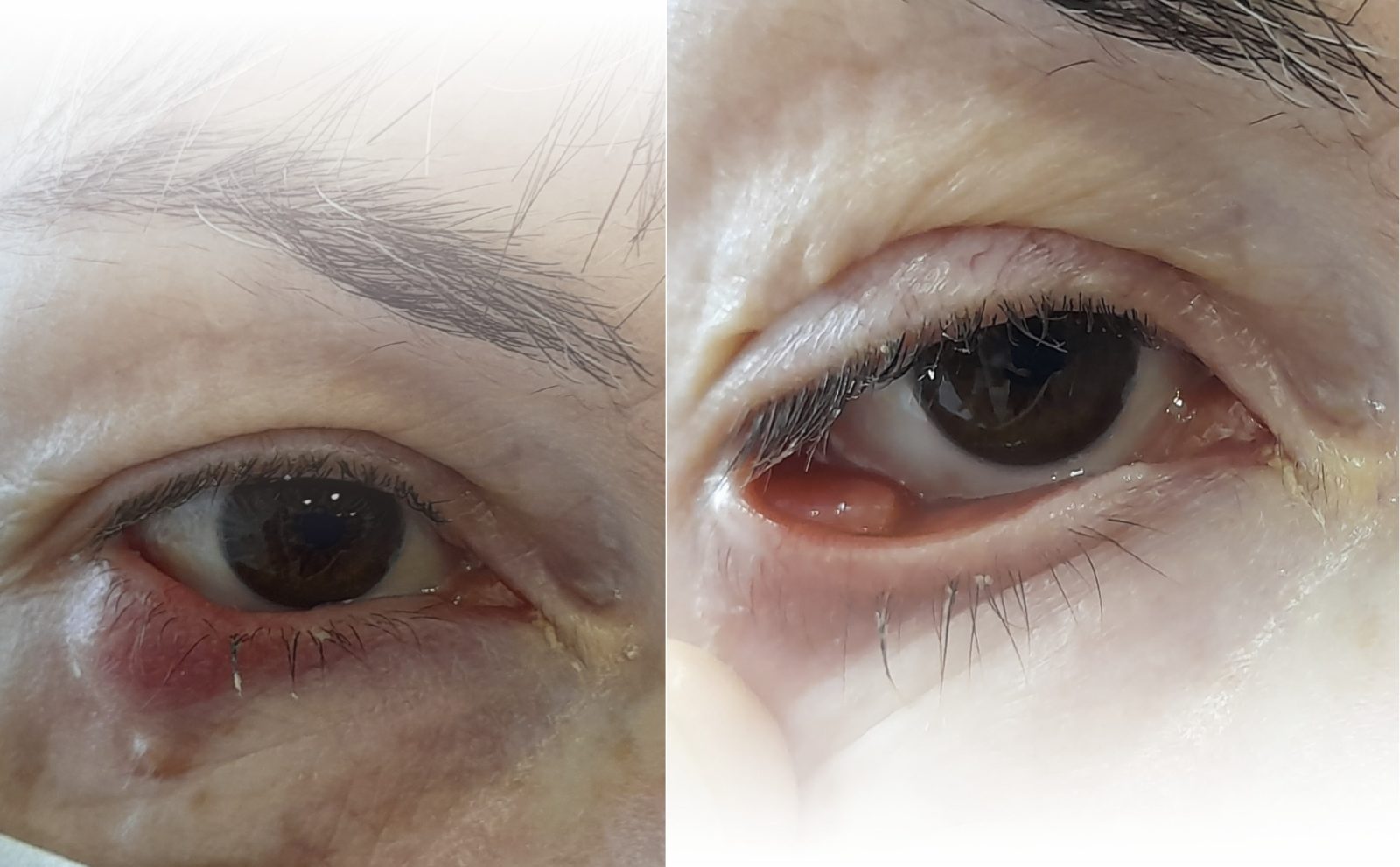 Granuloma piógeno infraorbitario
