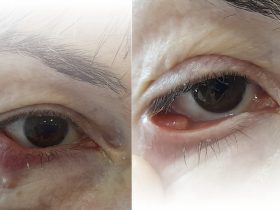 Granuloma piógeno infraorbitario