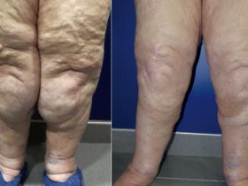 lipoescultura
