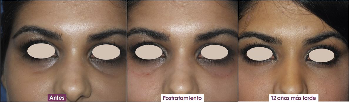 corrección de ojeras
