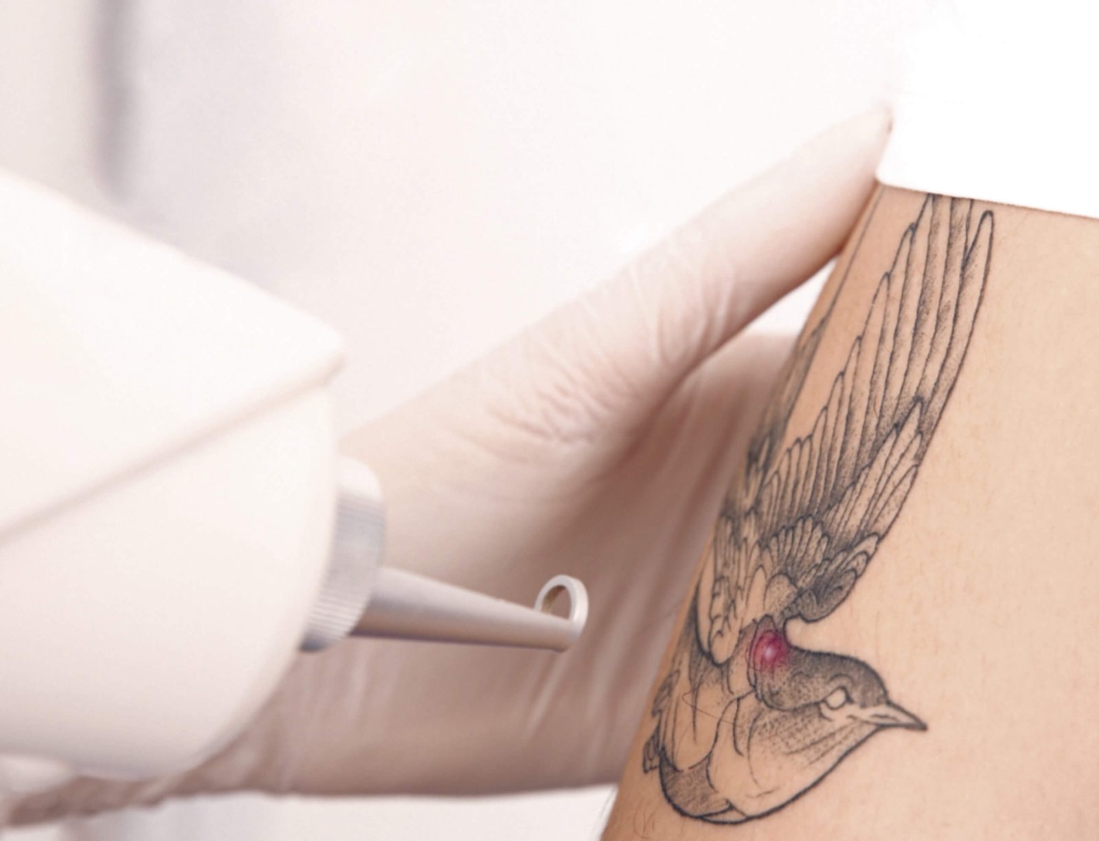 eliminacion de tatuajes con laser