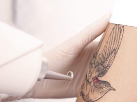 eliminacion de tatuajes con laser