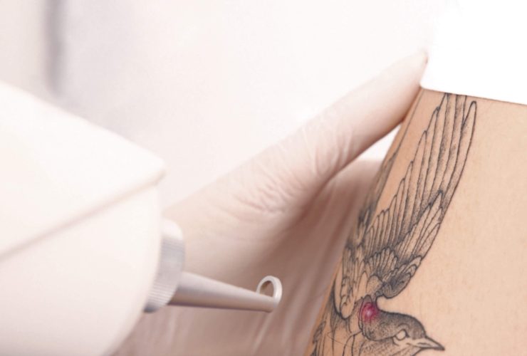 eliminacion de tatuajes con laser