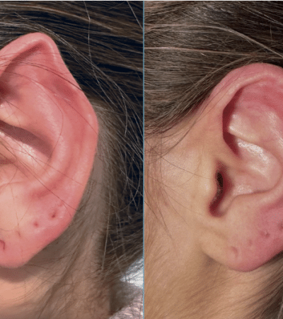 otoplastia