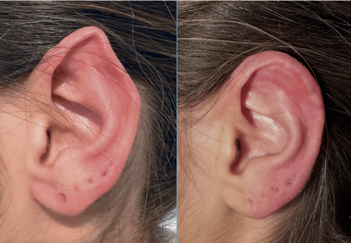 otoplastia