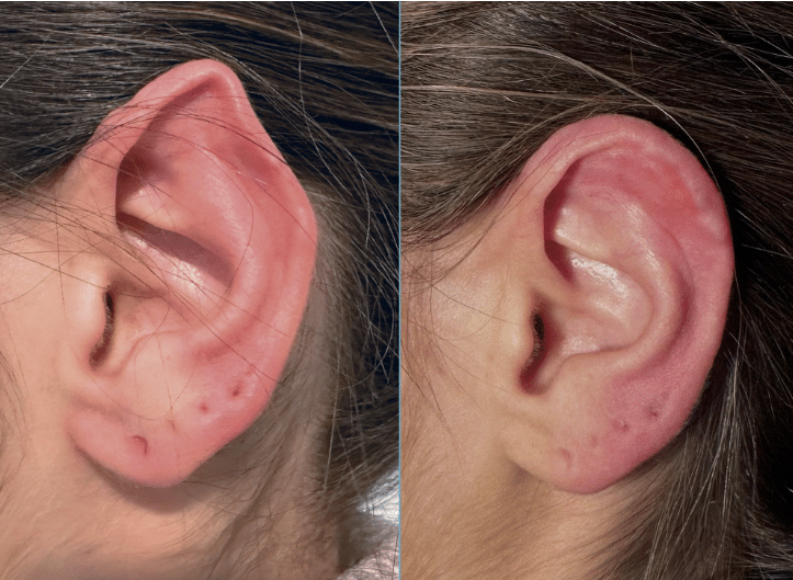 otoplastia