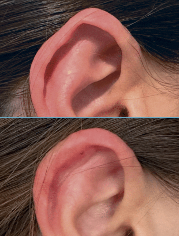 otoplastia