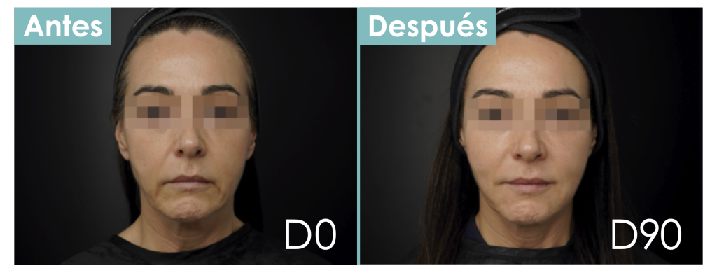 mesofiller nexha