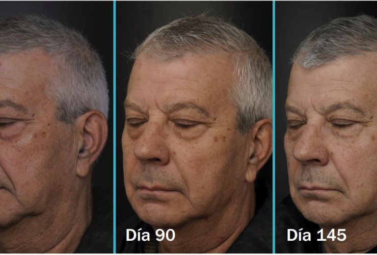 Lift 85