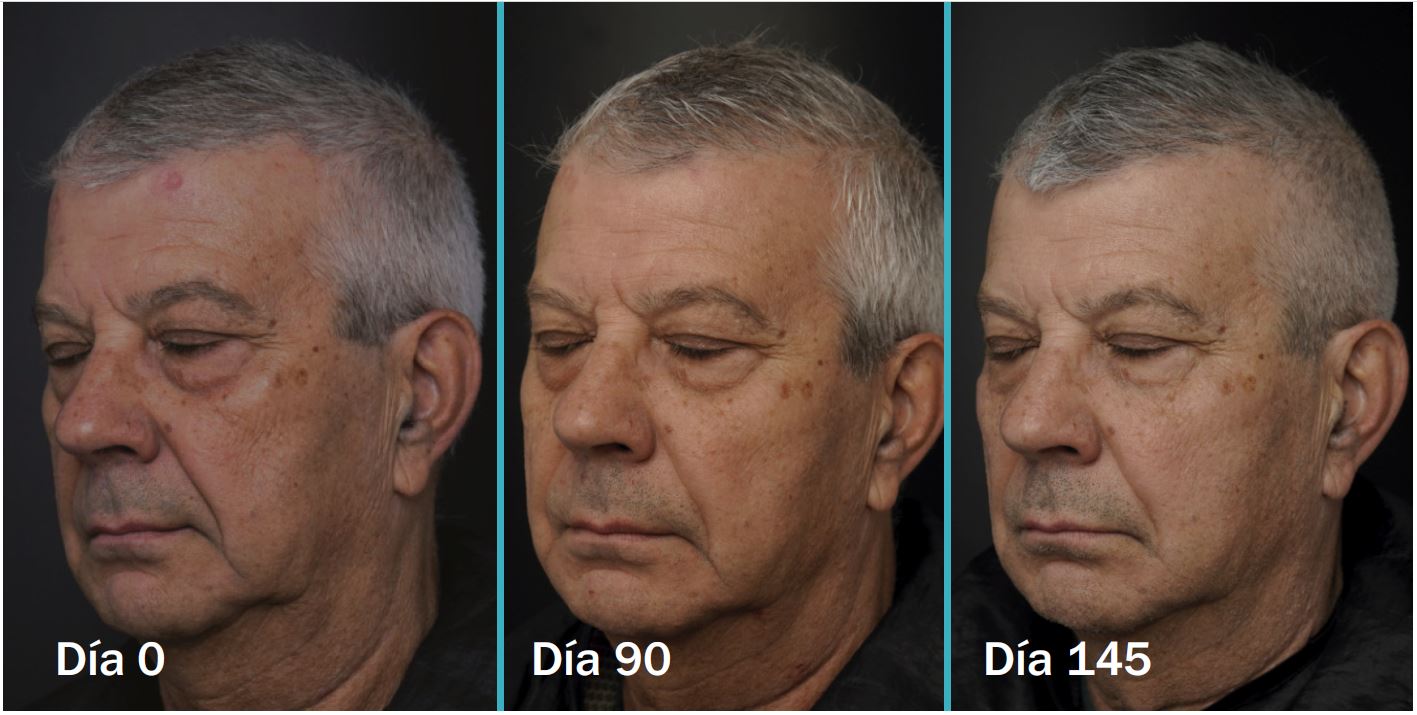 Lift 85