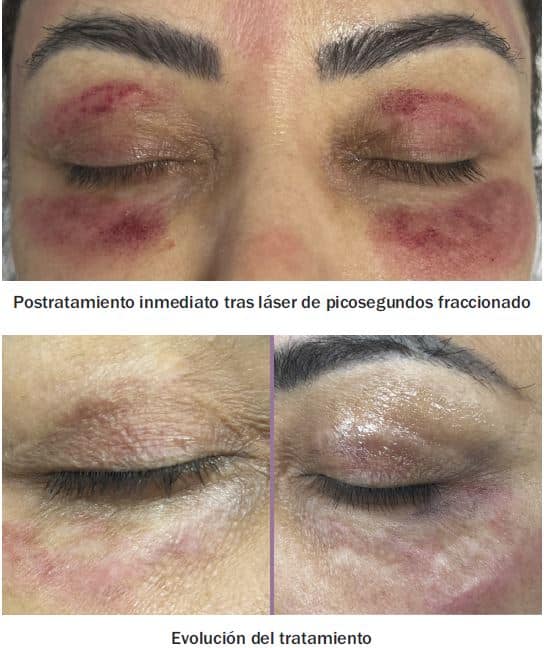 Cicatrices hipertróficas perioculares