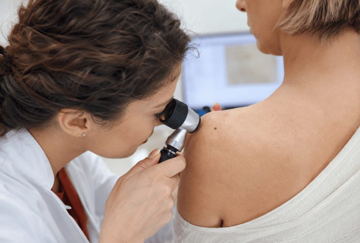 Dermatólogo revisando un lunar con dermatoscopio, vacuna del melanoma