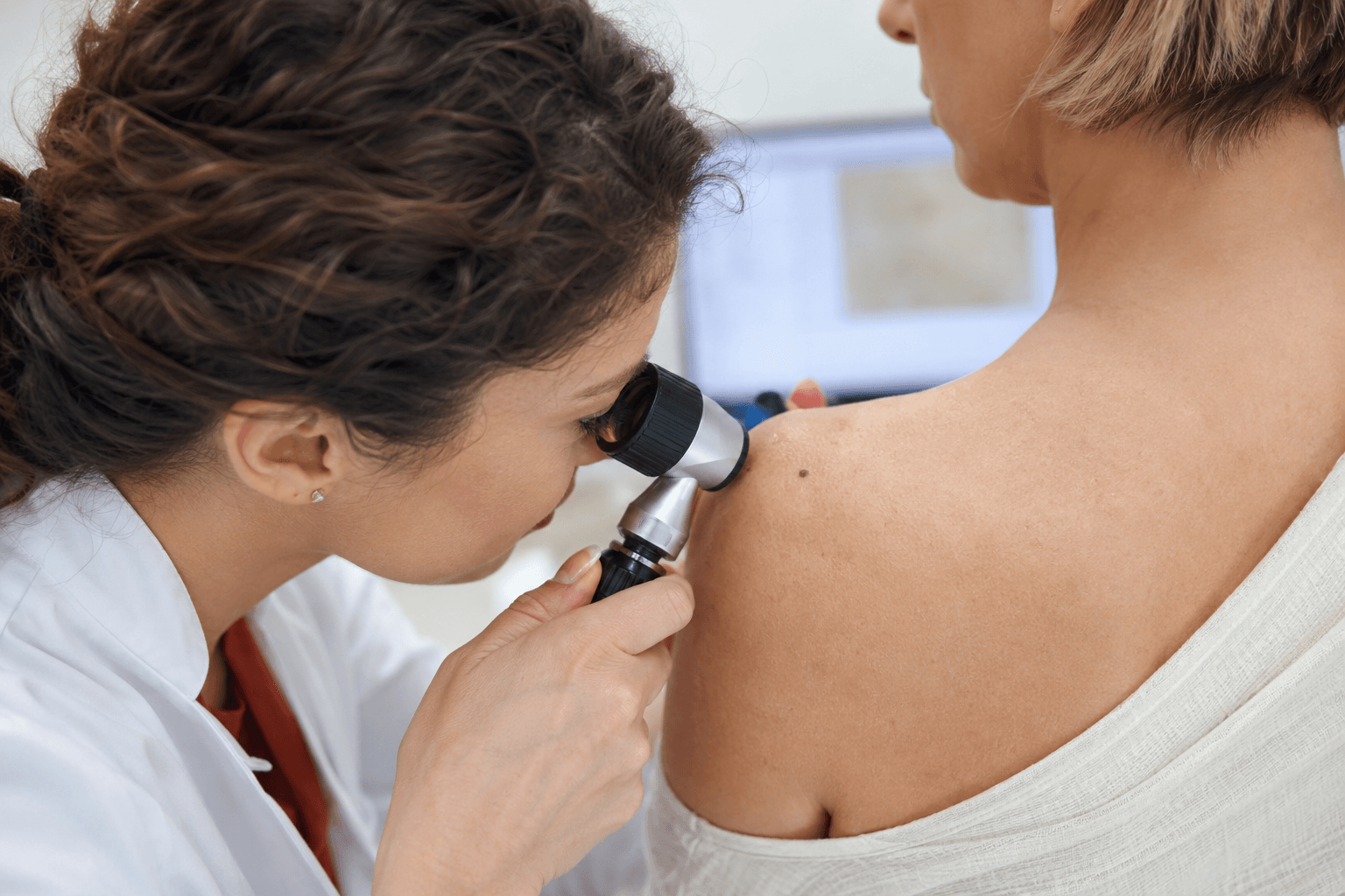 Dermatólogo revisando un lunar con dermatoscopio, vacuna del melanoma